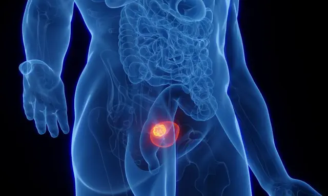 Widok anatomiczny ukazujący nowotwór złośliwy pęcherza moczowego.