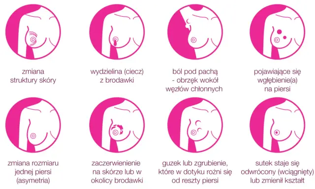 Grafika pokazuje objawy raka piersi: guzek, zmiany skórne, wydzielinę z brodawki, ból, wgłębienia, asymetrię, zaczerwienienie i odwrócony sutek.