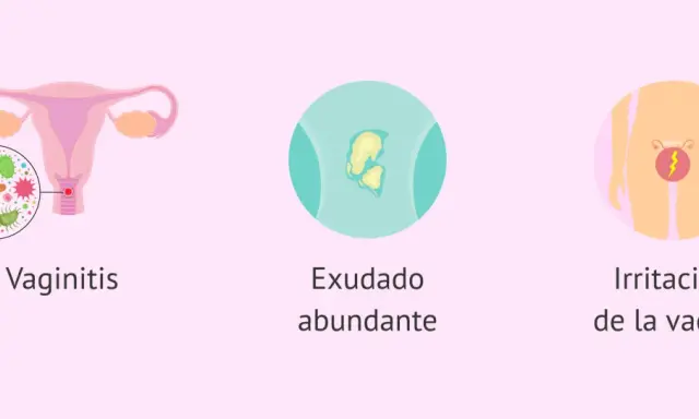 Ilustración de vaginitis, exudado y picazón vaginal, síntomas comunes de tricomoniasis.