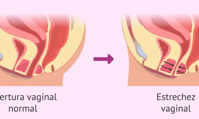 Ilustración comparativa de la abertura vaginal normal y la estrechez vaginal, donde se aprecian espasmos musculares en la segunda.