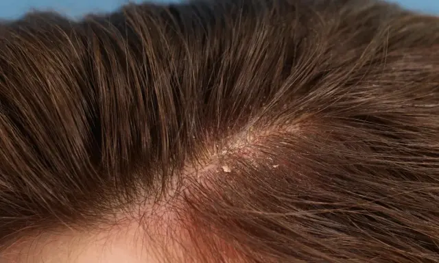 Gros plan sur un cuir chevelu avec des pellicules visibles, expliquant pourquoi j'ai des pellicules.