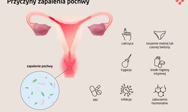 Ilustracja przedstawia przyczyny zapalenia pochwy: cukrzyca, mokra bielizna, irygacja, środki higieny intymnej, leki, infekcje, zaburzenia hormonalne.