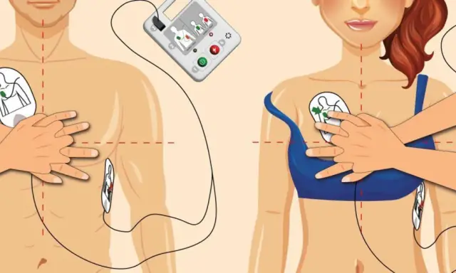 Instrukcja użycia defibrylatora serca. Elektrody przyklejane są do klatki piersiowej mężczyzny i kobiety, zgodnie z rysunkami.