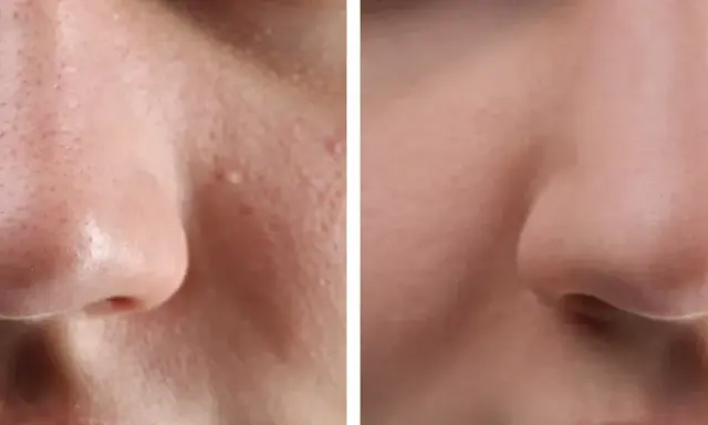 Avant/après : peau du nez avec points noirs avant et après extraction, montrant une peau plus lisse et nette.
