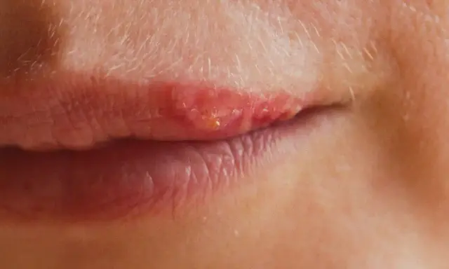 Gros plan sur une lèvre avec un bouton de fièvre rouge et enflammé, suggérant un traitement en cours.