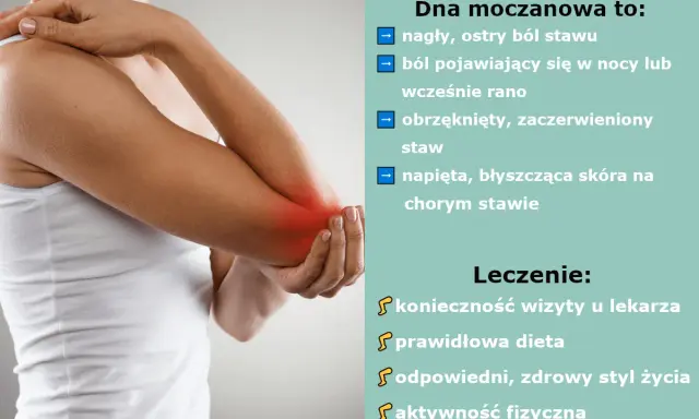 Dna moczanowa: nagły ból stawu, obrzęk, zaczerwienienie i napięta skóra. Leczenie: wizyta u lekarza, dieta, zdrowy styl życia, aktywność fizyczna.