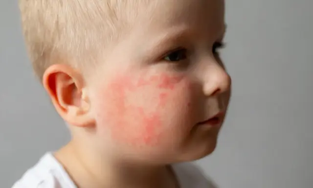 Visage d'un bébé aux joues rouges et irritées, signe de dermatite atopique.