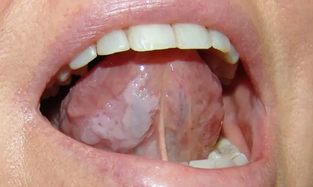 Lingua con aree biancastre, possibile leucoplachia, che potrebbe indicare un tumore alla lingua.