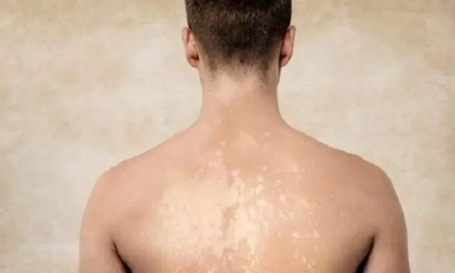 Dos de homme montrant des taches blanches sur la peau, possiblement dues à une exposition au soleil.