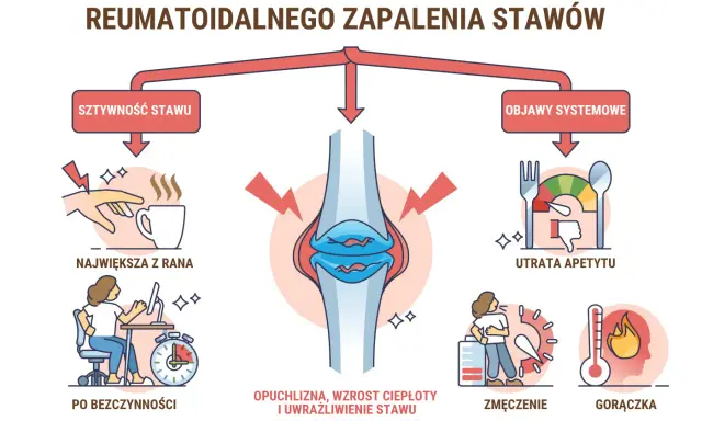 Wczesne oznaki reumatoidalnego zapalenia stawów: sztywność, opuchlizna, zmęczenie, gorączka, utrata apetytu. Test na RZS.