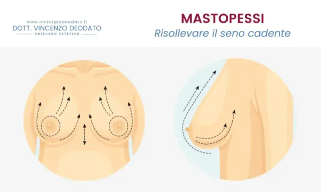 Mastopessi: solleva il seno cadente. Immagine illustra il seno prima e dopo il sollevamento, con frecce che indicano il movimento verso l'alto.