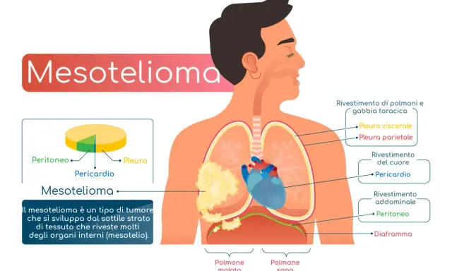 Il mesotelioma è un tumore che colpisce il mesotelio, il sottile strato che riveste gli organi interni. L'immagine mostra dove può svilupparsi.