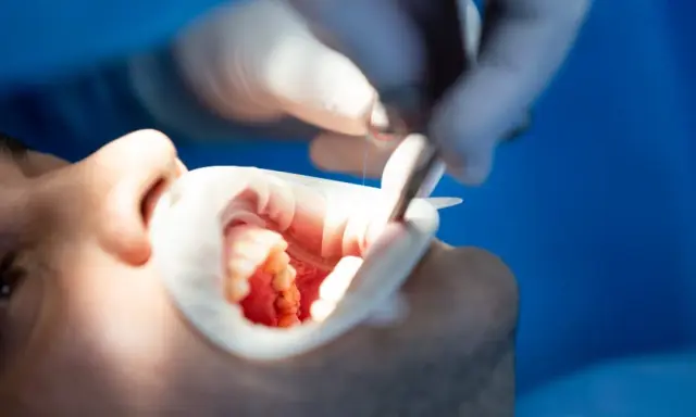 Jak skutecznie leczyć zapalenie dziąseł? Dom, apteka, dentysta