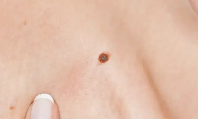 Gros plan sur une peau humaine, montrant une texture légèrement granuleuse, un grain de beauté brun et le bord des lèvres.