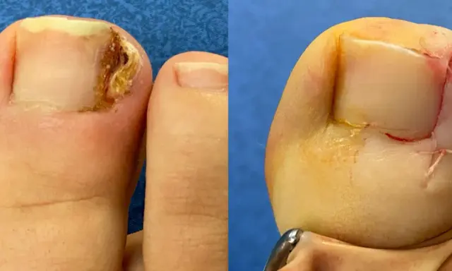 Avant/après chirurgie d'un ongle incarné douloureux par un podologue. Le pied gauche montre l'ongle abîmé, le droit, après intervention, suturé.