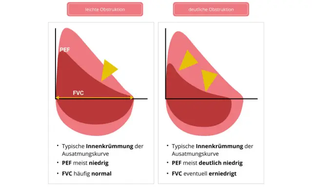 Diagramm zeigt Lungenfunktion bei Asthma. Links leichte Obstruktion mit PEF meist niedrig, rechts deutliche Obstruktion mit PEF deutlich niedrig.