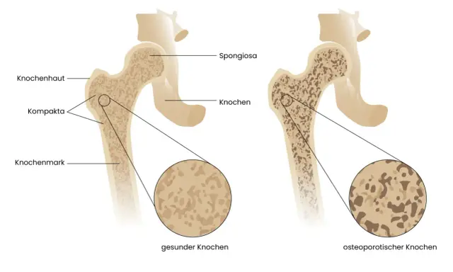 Vergleich gesunder und osteoporotischer Knochen. Rauchen kann Osteoporose fördern, indem es die Knochendichte verringert.
