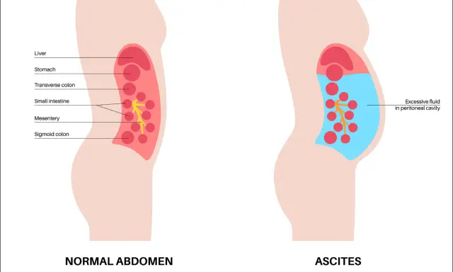 Ilustracja porównująca prawidłowy brzuch z brzuchem z wodobrzuszem (ascites), pokazująca nagromadzenie płynu.