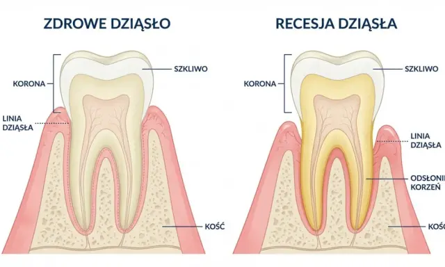 Porównanie zdrowego dziąsła z recesją, gdzie odsłonięty korzeń zęba jest widoczny. Rąbek ołowiowy jest tu kluczowym elementem.