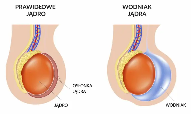 Porównanie prawidłowego jądra z wodniakiem jądra, który może pojawić się po operacji przepukliny pachwinowej.