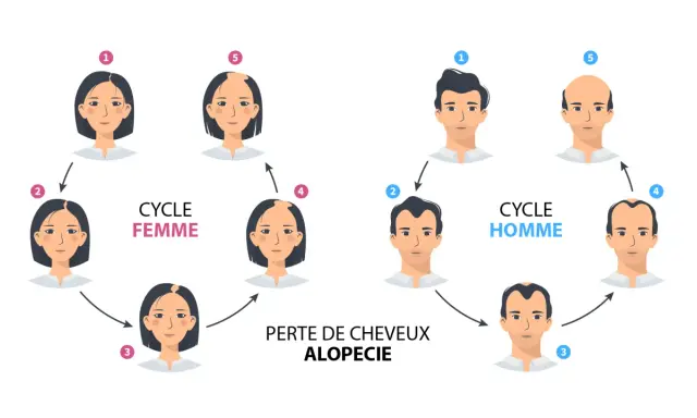 Illustration du cycle de la perte de cheveux, montrant l'alopécie chez la femme et l'homme.
