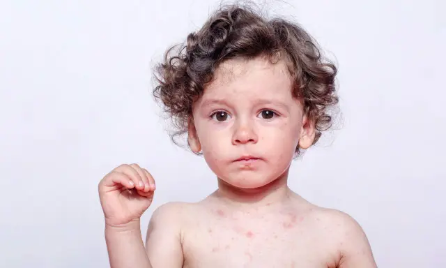 Bambino con puntini rossi sul corpo e viso, possibili puntini rossi eritema solare bambini.