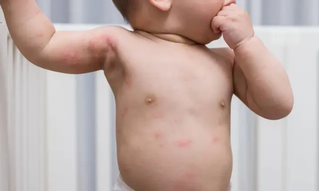 Un bébé a des rougeurs et des petits boutons sur le corps, notamment sur le torse et les bras.