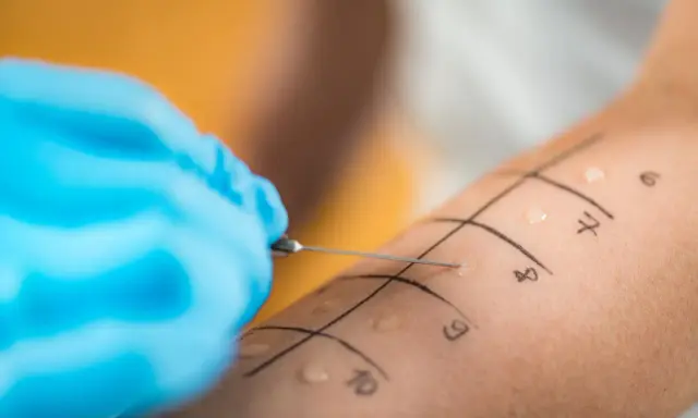 Ręka z zaznaczonymi polami do testów alergicznych skórnych. Igła wprowadza alergen, rozpoczynając diagnostykę.