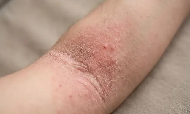 Bras atteint de dermatite atopique, avec peau rouge, sèche et squameuse, quelques petites vésicules.