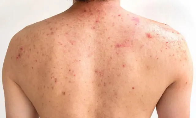 Le dos d'une personne présente de nombreuses imperfections rouges et enflammées, typiques de l'acné du dos.