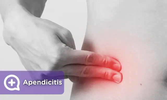 Apendicitis: ¿Dolor común o urgencia? Identifica los síntomas clave.