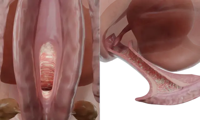 Vista 3D del canal vaginal con aspecto blanquecino y rugoso, indicativo de síntomas de candidiasis vaginal.