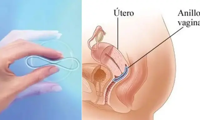 Anillo vaginal anticonceptivo en mano y su ubicación en el útero. No se debe quitar el anillo anticonceptivo durante relaciones.