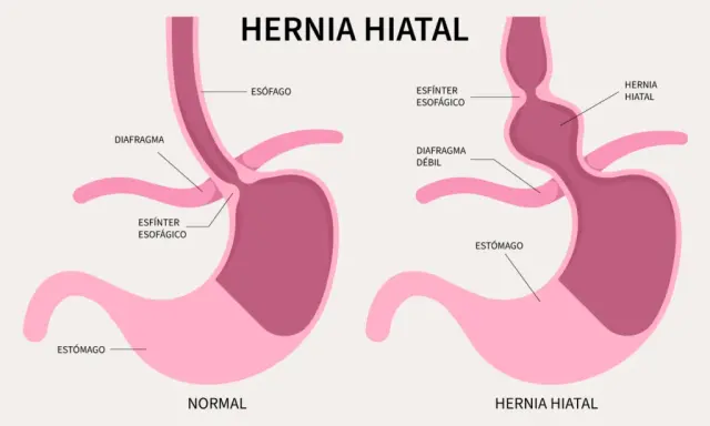 Hernia de hiato: Identifica sus síntomas y cuándo buscar ayuda.