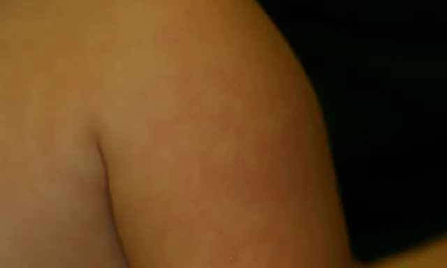 Éruption cutanée sur le bras, possiblement du pityriasis alba. Le traitement est souvent simple et vise à hydrater la peau.