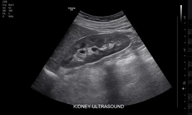 Obraz USG nerki. Czy usg jamy brzusznej wykryje raka? Badanie pokazuje strukturę nerki, pomagając w diagnostyce.