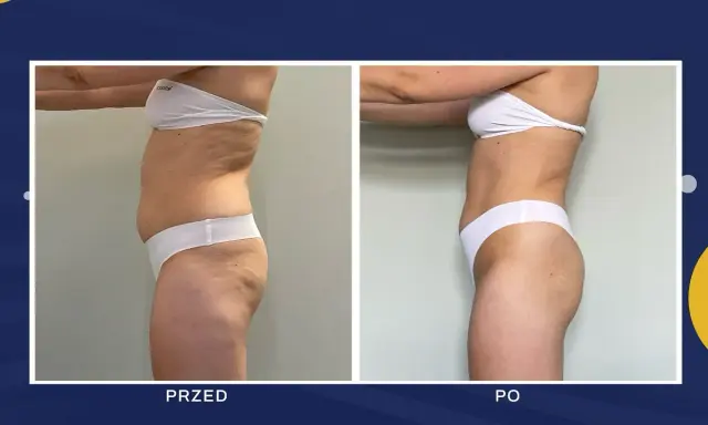 Liposukcja: Modelowanie sylwetki czy odchudzanie? Poznaj prawdę