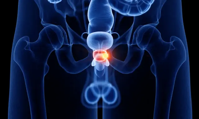 Anatomical illustration of male pelvic organs, highlighting the prostate with a red glow, suggesting inflammation. To understand czemu po alkoholu boli prostata, this image shows the affected area.