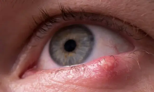 Gros plan sur un œil avec une tache rouge sur la paupière supérieure, près des cils.