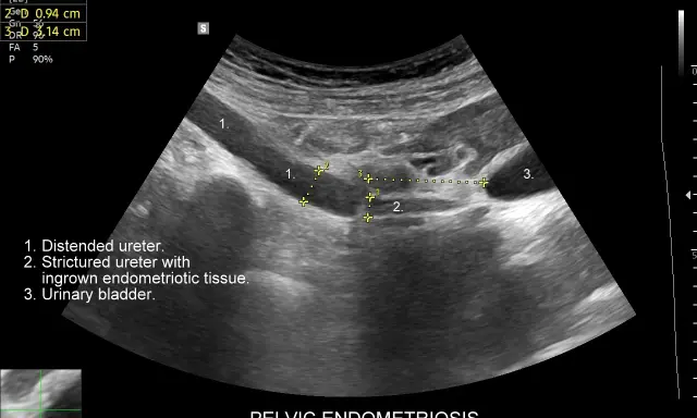 USG miednicy: poszerzony i zwężony moczowód z tkanką endometrialną, pęcherz moczowy.