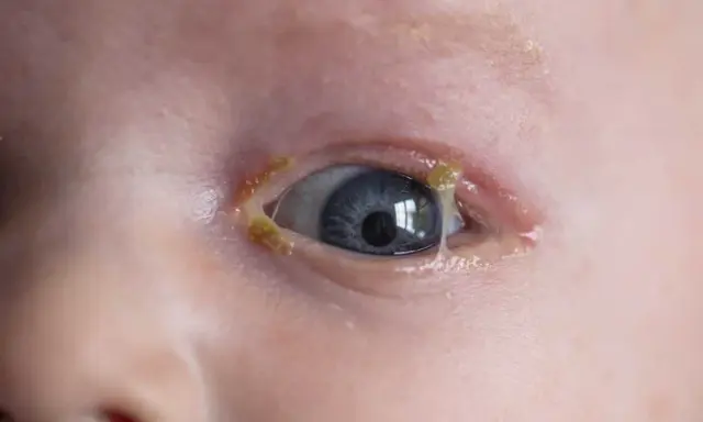 Occhio di bambino con secrezioni giallastre, sintomo di congiuntivite.