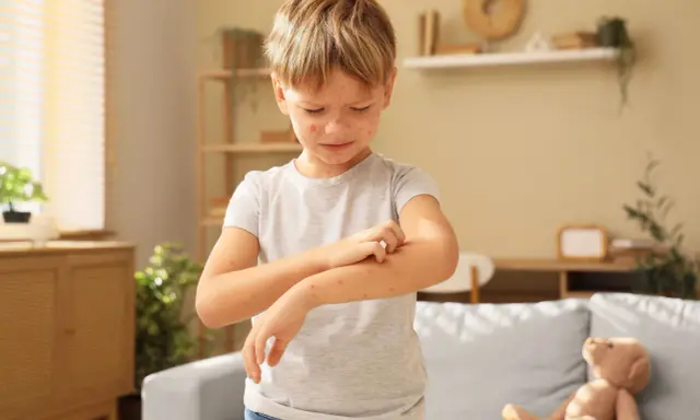 Niño con varicela en brazos y cara, rascándose el brazo.