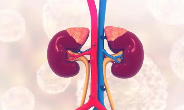 Anatomia nerek z naczyniami krwionośnymi. Grafika może sugerować stan zapalny, wpływający na ropień nerki rokowania.
