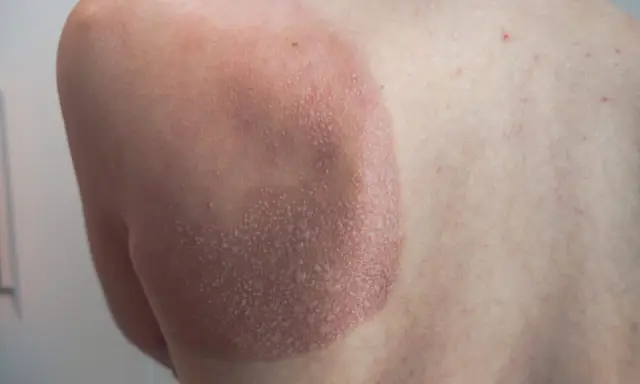 Une petite cloque d'eau sur la peau, signe d'un coup de soleil. La zone affectée est rouge et légèrement écailleuse.