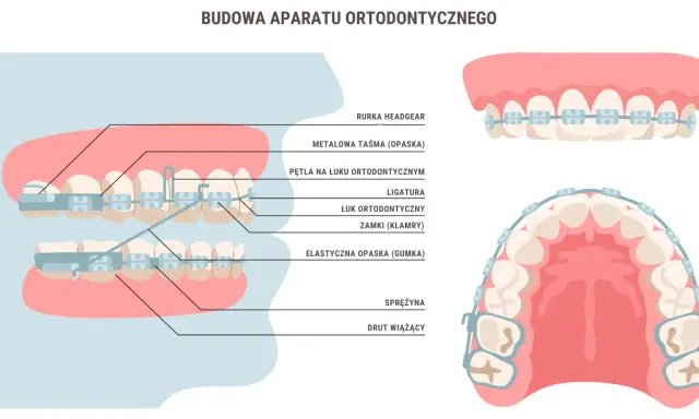 Aparat ortodontyczny a wypadanie zębów: Prawda czy mit?