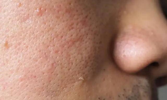 Gros plan sur la peau d'un visage, montrant des pores dilatés et une petite verrue sur la joue.