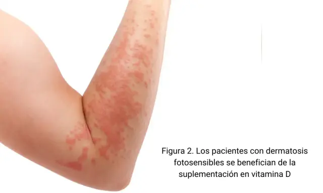 Brazo con erupción cutánea roja y escamosa.