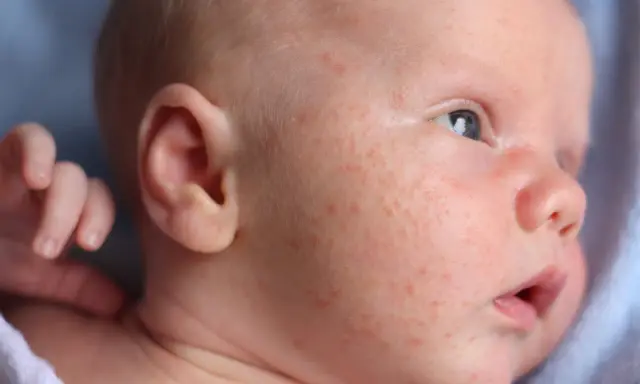 Nahaufnahme eines Babys mit roten Pickelchen im Gesicht. Die Frage "Babyakne wie lange" beschäftigt viele Eltern.