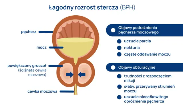 Ilustracja przedstawia łagodny rozrost stercza (BPH) i jego objawy, które mogą dotyczyć 60-latka: podrażnienie pęcherza i trudności z oddawaniem moczu.