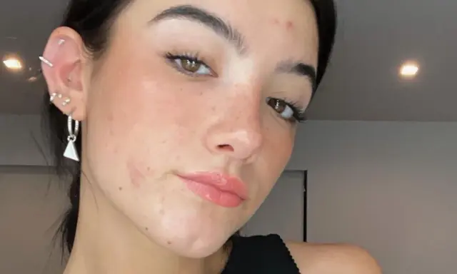 Gros plan sur le visage d'une jeune femme aux yeux marron, avec un bouton sur le front et des boucles d'oreilles.